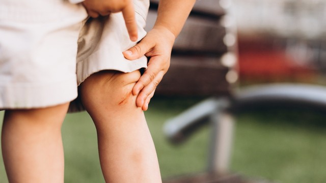 Ilustrasi lutut balita karena sering terjatuh Foto: Shutterstock