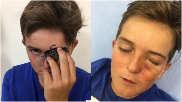 Seorang anak tersangkut kail pancing di matanya. Foto: Facebook/ @Daniel Ruff