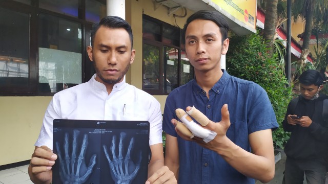 Novi Fransiska Aditama (kanan) menunjukkan tangannya yang habis dipalu bosnya, Rabu siang (14/8). foto: Gigih Mazda/tugumalang.id
