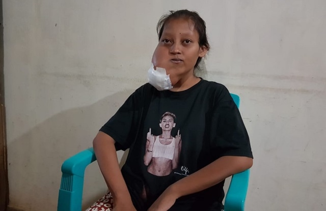 Frili Sisilia Pemunda duduk lesu karena tumor yang menyerang wajahnya bisa memicu rasa sakit luar biasa di bagiah wajahnya (Foto: Isa Anshar Jusuf)