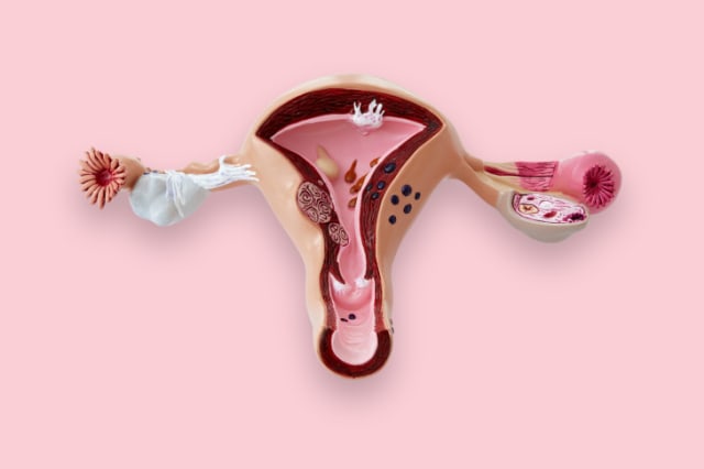 Bagaimana Endometriosis Mengganggu Kehidupan Wanita
