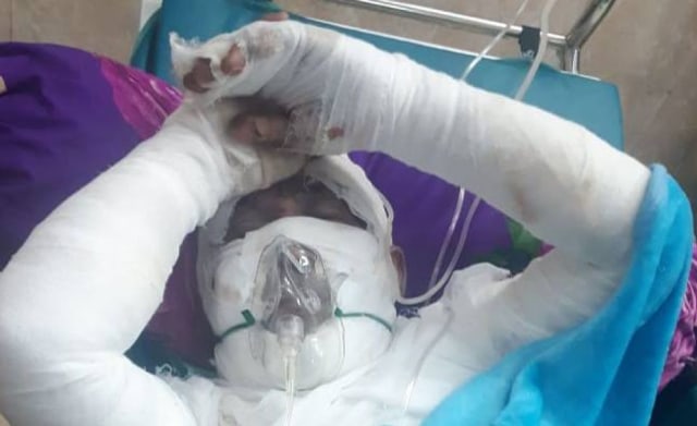 Sunjoko korban ledakan bondet dirawat di RSUD R Soedarsono Pasuruan