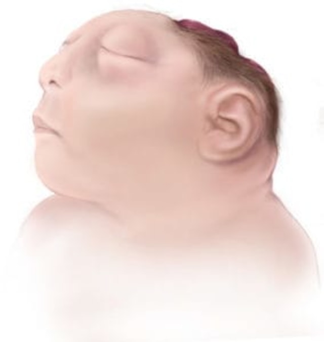 Ilustrasi bayi tanpa tulang tengkorak. Foto: Centers for Disease Control and Prevention
