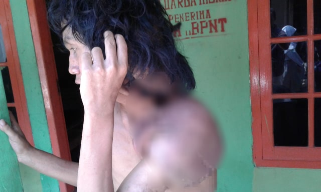 Jazuli, 21 Tahun Hidup dengan Daging Tumbuh Melambai