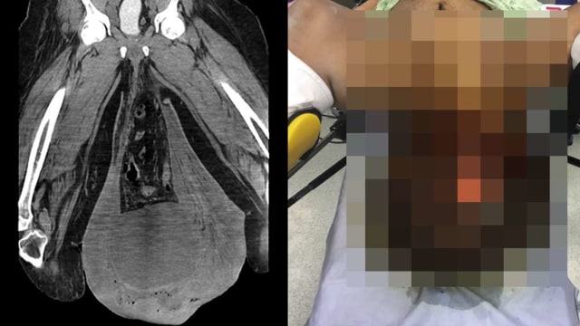 Kantong zakar seorang pria di Panama bengkak sampai melebihi lutut. Foto: Urology Case Reports (CC BY-NC-ND 4.0)