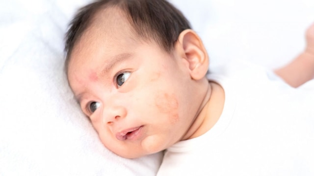 Apa itu Dermatitis Atopik atau Eksim?