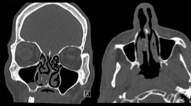 Hasil CT Scan menunjukkan ada beda kecil berwarna abu-abu dalam hidung pria tersebut. Foto: Journal BMJ Case Reports