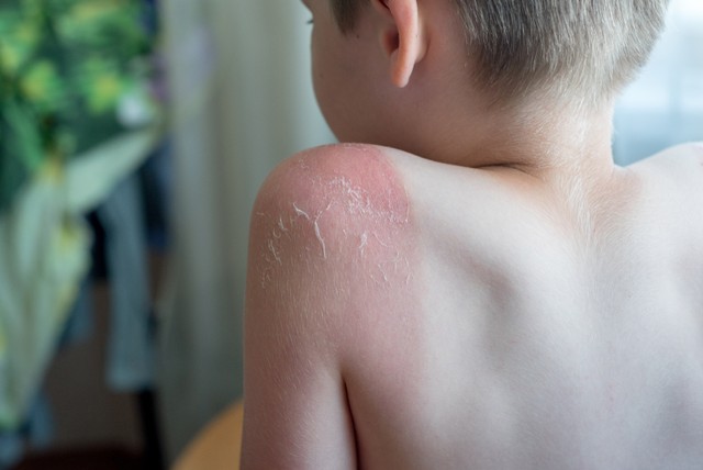 Ilustrasi Anak Alami Luka Bakar Ringan. Foto: Shutterstock