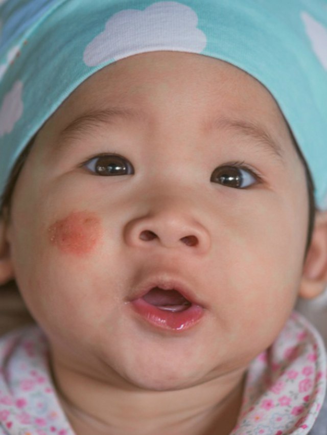 Ilustrasi eksim pada bayi. Foto: Shutterstock