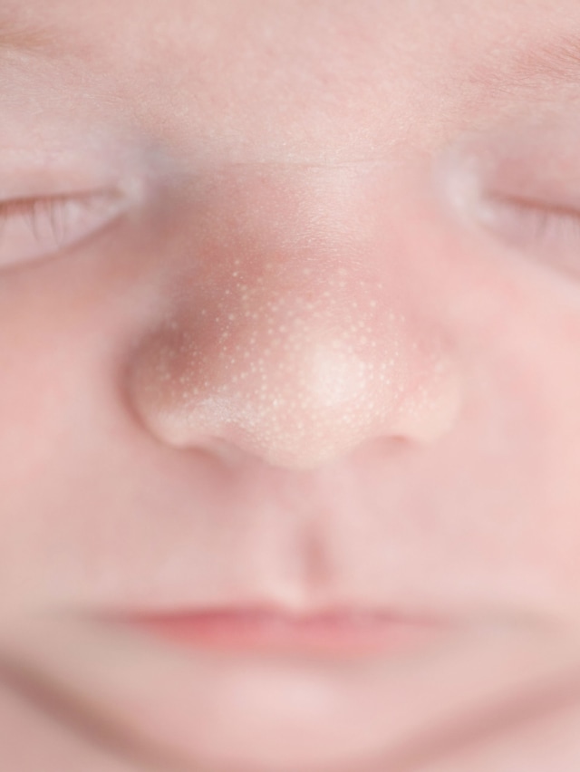 Ilustrasi bayi punya milia. Foto: Shutterstock