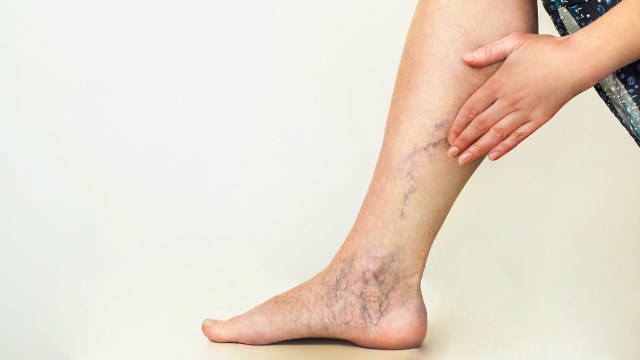 Ilustrasi varises pada kaki. Foto: Shutterstock