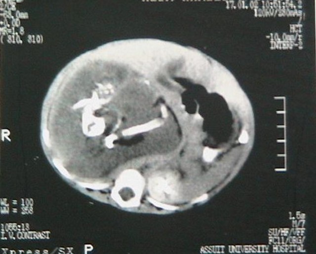 Hasil pemindaian tomografi janin fetus in fetu.