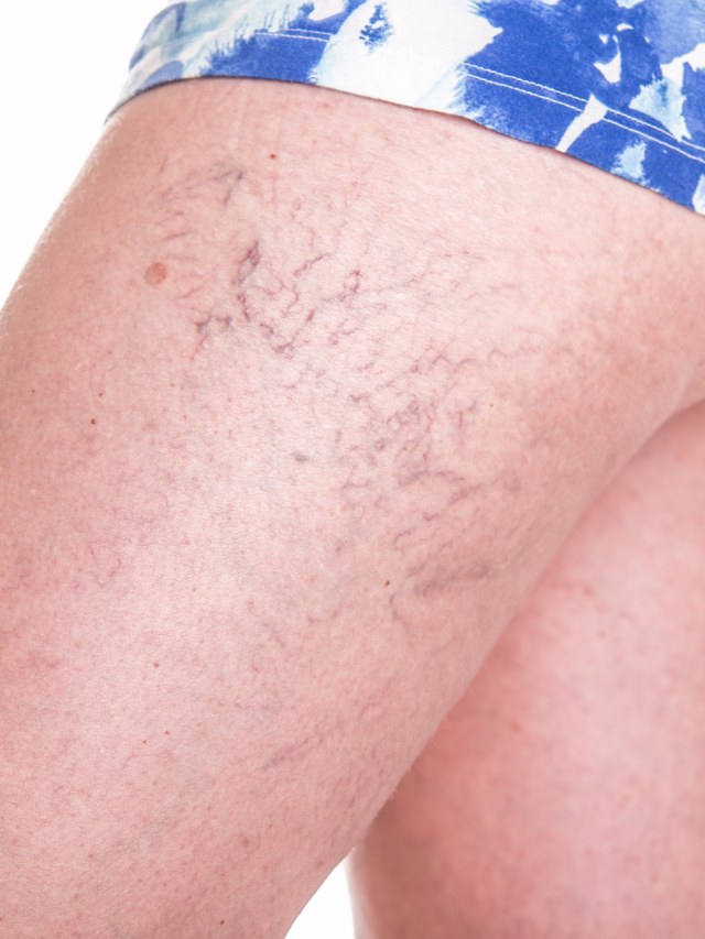 Ilustrasi Spider Veins. Foto: Shutter Stock 