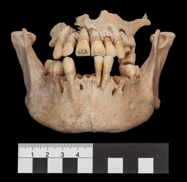 Seorang individu dari kuburan massal Uxul memiliki ukiran ornamen di gigi seri atasnya. Foto: University of Bonn/Nicolaus Seefeld