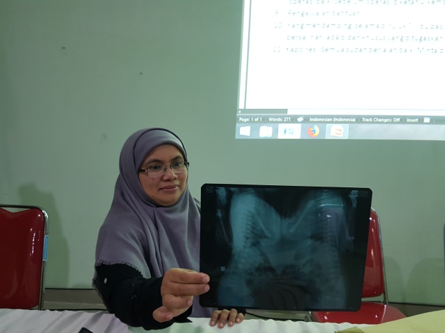 Dokter spesialis anak Diah Erma Prita Santi memperlihatkan hasil rogten bayi kembar dempet jantung. (Foot: Joko Hardyono)