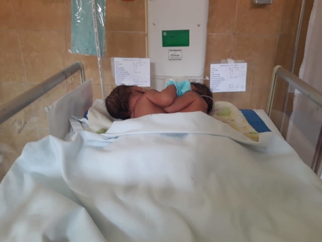 Bayi kembar dempet jantung dalam perawatan di ruang perinatologi level 2 di RSUD Sultan Imanuddin Pangkalan Bun. Dok: Joko Hardyono/InfoPBUN