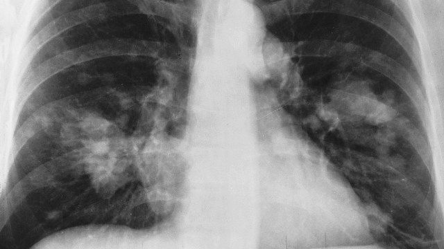 1200px-X-ray_chest_cancer.jpg