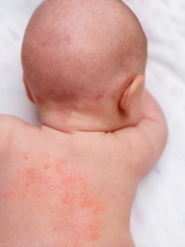 Biang keringat adalah masalah kulit yang rentan menyerang bayi Foto: Shutterstock