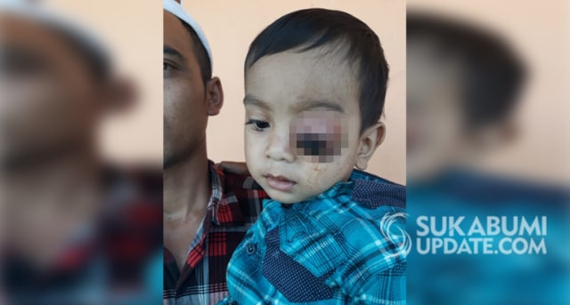 Muhammad Abdul Rohman (3 tahun), seorang balita asal Kampung Cimanggu RT 08/02 Desa Cianaga, Kecamatan Kabandungan, Kabupaten Sukabumi menderita tumor di mata kirinya. | Sumber Foto:Istimewa