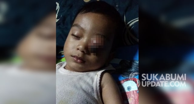 Muhammad Abdul Rohman (3 tahun), seorang balita asal Kampung Cimanggu RT 08/02 Desa Cianaga, Kecamatan Kabandungan, Kabupaten Sukabumi, menderita tumor di mata kirinya. | Sumber Foto:Istimewa
