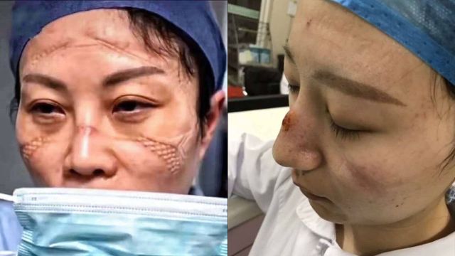 Kondisi wajah tenaga medis yang rawat pasien virus corona. Foto: Facebook/Rojaklah.com