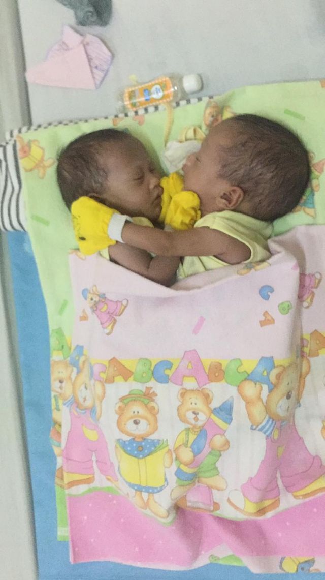 Bayi kembar siam M. Abdullah dan M. Ibrahim dirawat di RSSI Pangkalan Bun. (Foto: RSSI Pangkalan Bun)