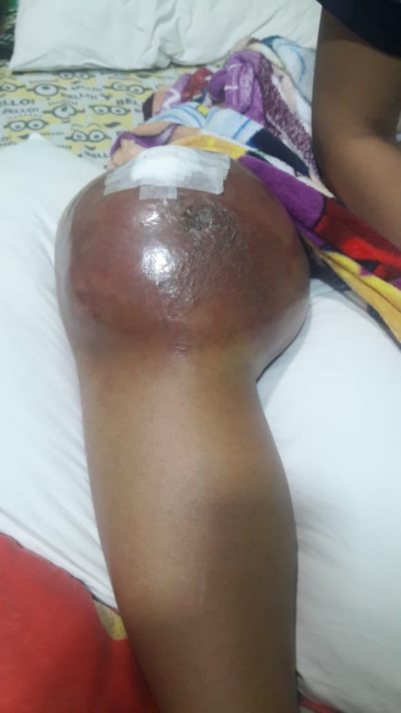 PEMBENGKKAN di lutut kaki kanan Riska Rahmadilla mulai pecah saat dirawat di RSPAD Jakarta. 
