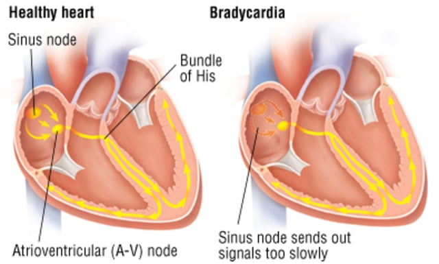 https://www.health.harvard.edu/a_to_z/bradycardia-a-to-z