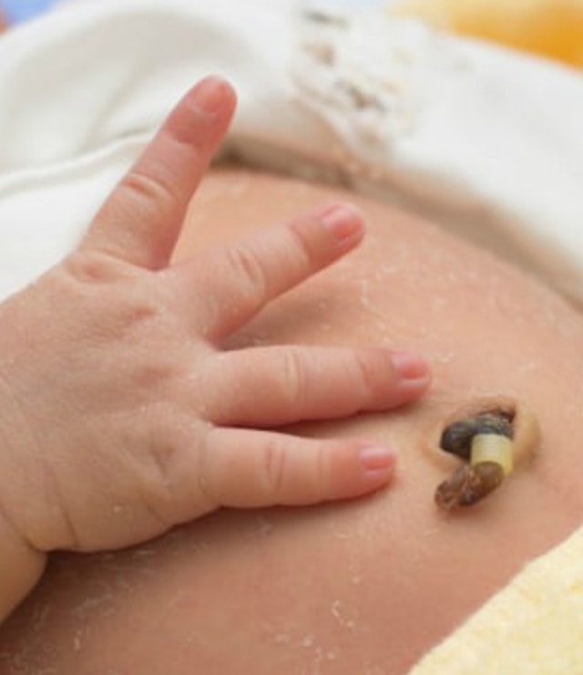 Ciri-ciri Tali Pusat Bayi Baru Lahir Mengalami Infeksi. Foto: Shutterstock