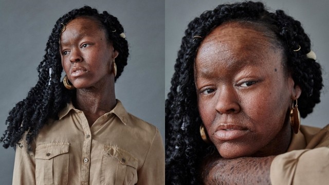 Jeyza Kaelani Gary, model dengan kondisi kulit Ichthyosis.
 Foto: Instagram/@lyricallydiverse