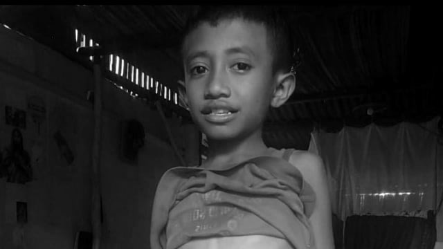 Constantino Soares, bocah berusia 11 tahun ini lahir tanpa memiliki lubang anus. Foto: istimewa. 