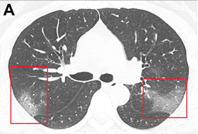 coronavirus_CT_imaging_RSNA_Radiology.jpg