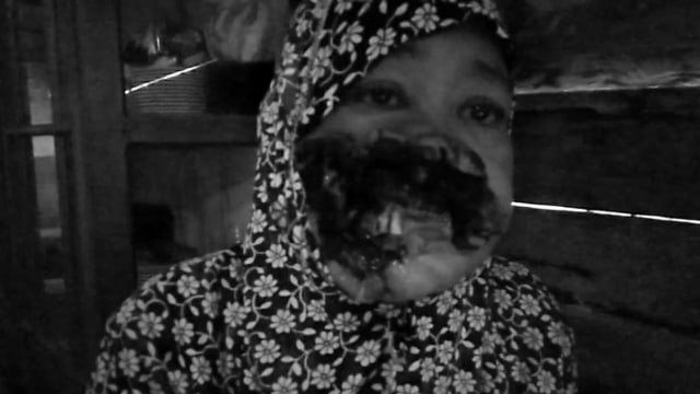 Salmiah (48), tujuh tahun menderita tumor ganas di bagian wajah. Foto: Dok. Istimewa