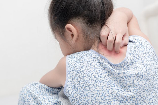Moms, Ini Tips Atasi Si Kecil yang Rewel Akibat Gejala Alergi Susu Sapi (240720)
