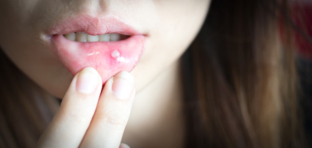 Ilustrasi sariawan di bibir. Foto: Shutterstock