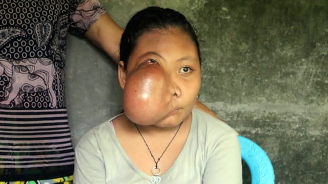 Chrismelia Ratundulage, penderita tumor di wajah asal Sangihe, Sulawesi Utara