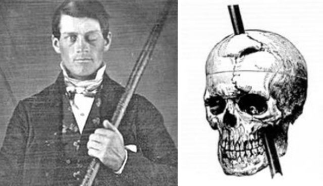 phineas-gage.png