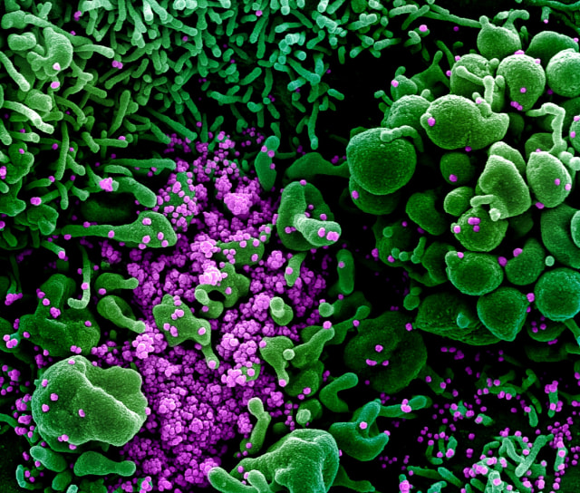 Sel apoptosis (hijau) terinfeksi SARS-CoV-2 (ungu)—virus penyebab COVID-19. Foto: NIAID Integrated Research Facility (IRF) via REUTERS
