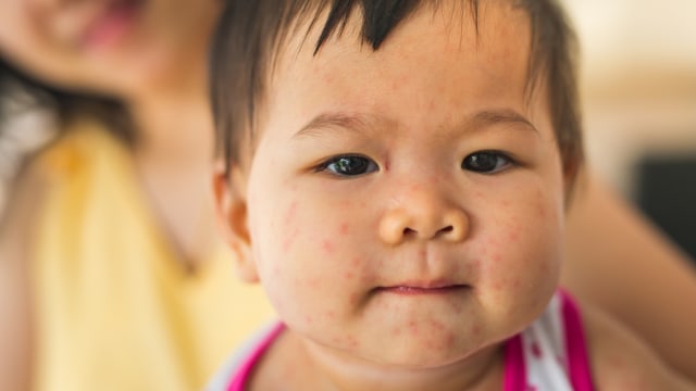 Gambar Anak Diare Ruam Merah Muncul di Kulit Anak  setelah Demam Bahaya 