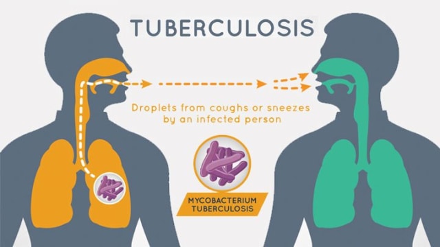 Hari Tuberkulosis Sedunia: Dalam Ancaman Tuberkulosis di Tengah Pandemi  Corona | kumparan.com