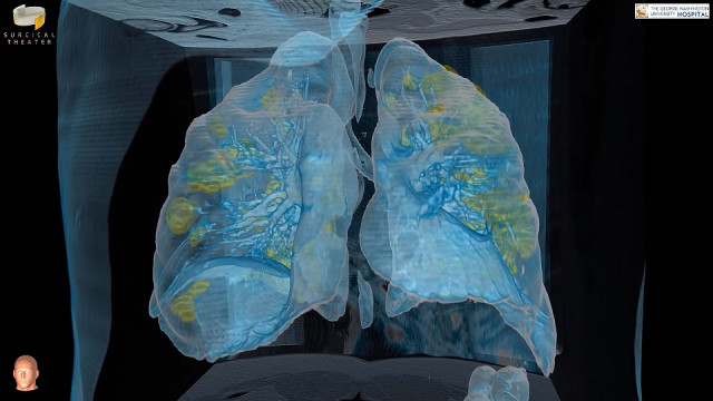 Tampilan render VR organ paru-paru pasien COVID-19. Foto: Dok. George Washington University Hospital/Surgical Theater