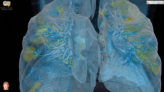 Tampilan render VR organ paru-paru pasien COVID-19