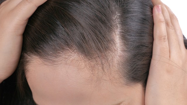  Ilustrasi rambut rontok setelah melahirkan. Foto: Shutter Stock