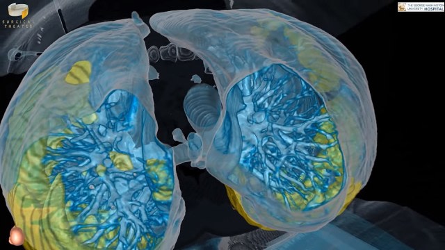 ampilan render VR organ paru-paru pasien COVID-19. Foto: Dok. George Washington University Hospital/Surgical Theater. 