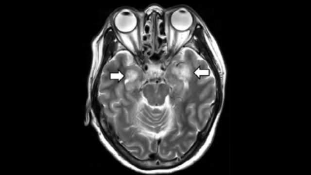 Scan MRI dari seorang wanita yang dites positif COVID-19 mengungkapkan bukti kerusakan jaringan. Foto: Radiological Society of North America