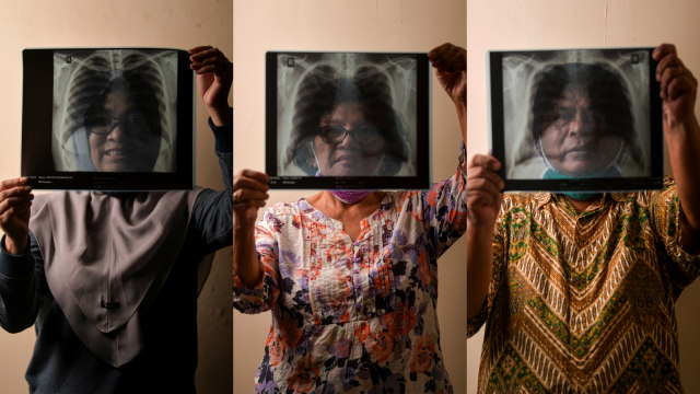 Dwieky Siti Rhomdoni, Peberia Tinambunan, dan Alben Sitohang menunjukkan hasil rontgen paru-paru miliknya di Jakarta.  Foto: ANTARA FOTO/Nova Wahyudi