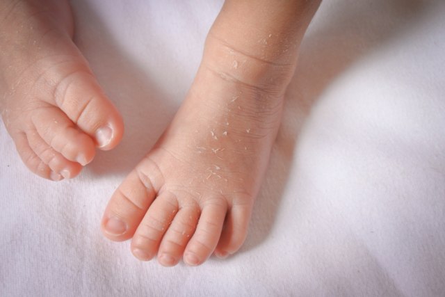 com-Ilustrasi kulit bayi yang kering. Foto: Shutterstock