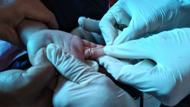 Petugas Damkar Cimahi bantu lepaskan cincin dari jari manis bocah empat tahun. Foto: Istimewa