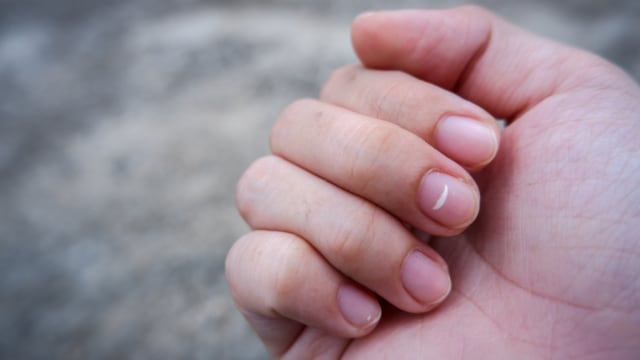 Waspada! Bercak Putih di Kuku Anak Bisa Jadi Tanda Masalah Kesehatan (125346)