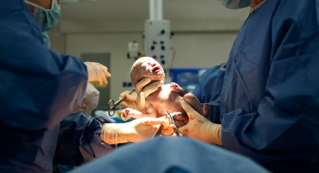 Ilustrasi melahirkan dengan operasi caesar. Foto: Shutterstock